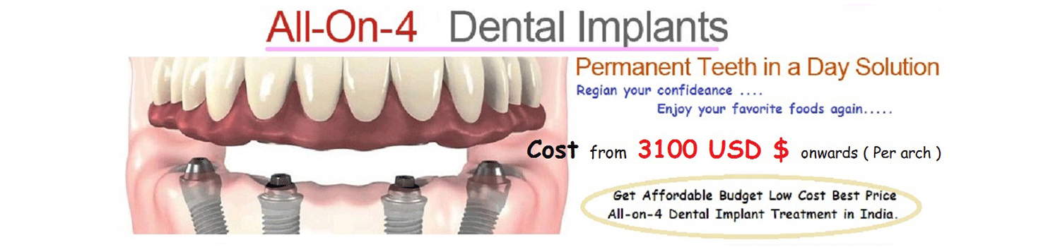 All on 4 Implants IndiaAll on 4 Implants India