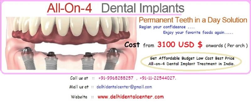 all-on-four-cost-india-full-mouth-dental-implant-clinic-in-delhi-india