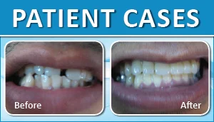 Top All-On-8 Dentist India 2 Dental Braces Delhi