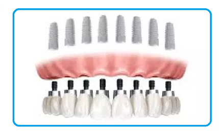 Dental implant cost 2019