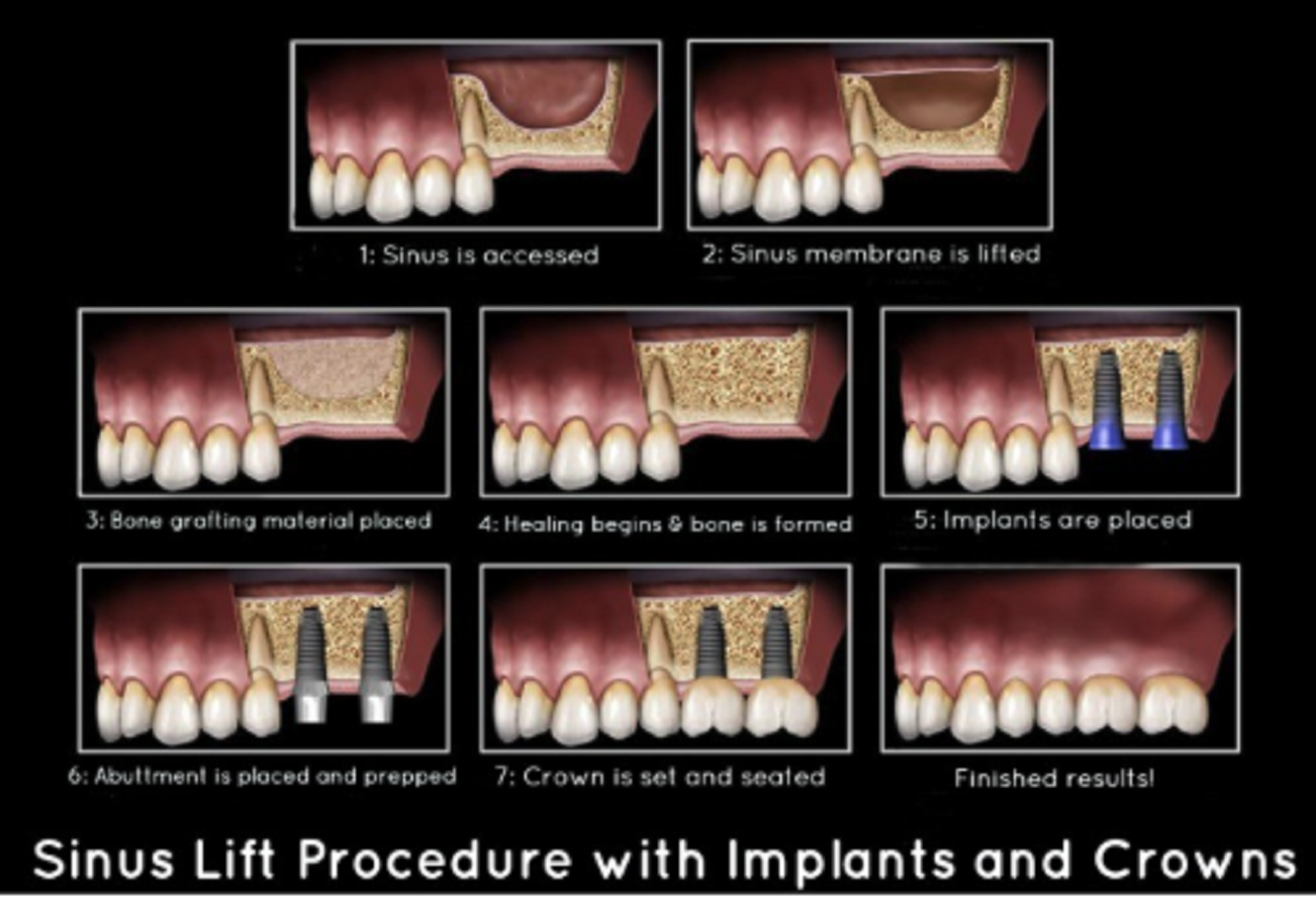 Sinus Lift Procedure For Dental Implants Placement