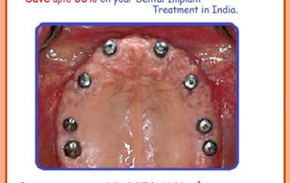 Full Mouth Dental Implant in India
