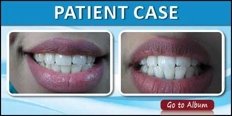 Dental Whitening in Delhi 1 1 1