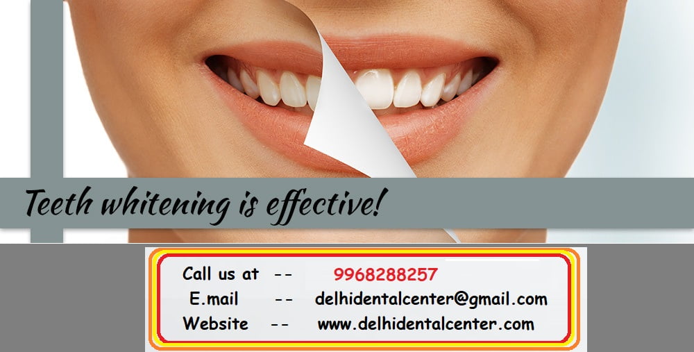 teeth whitening treatment in Delhi 1