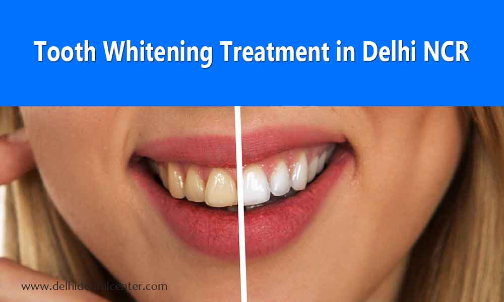 tooth whitening 1