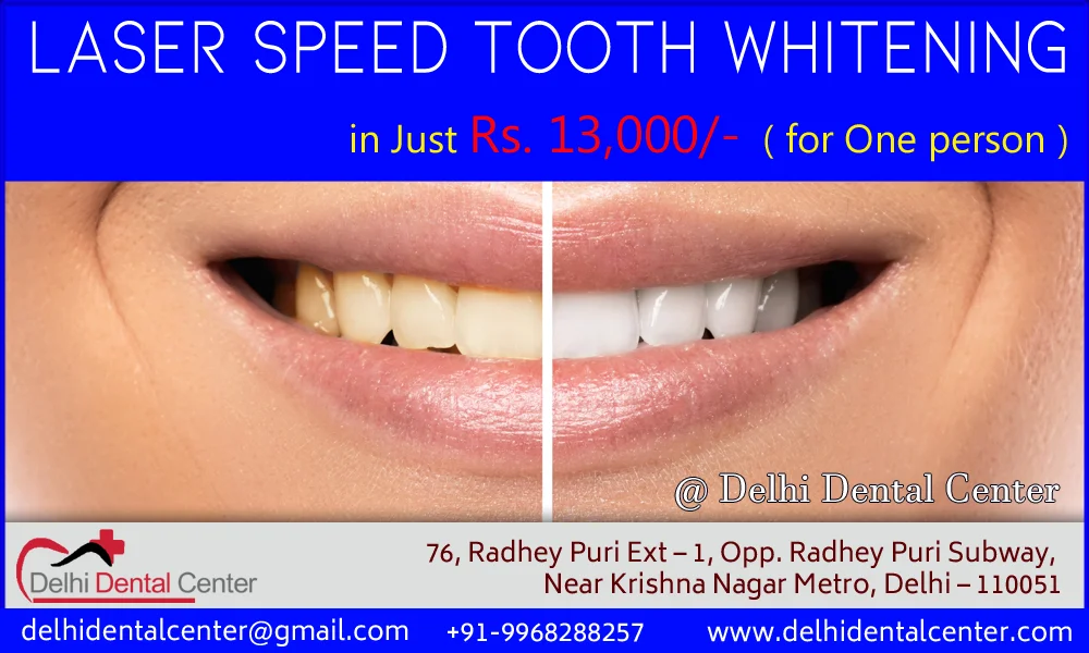 Tooth Whitening Dental Clinic in Shakarpur 1 white25 feb20 3