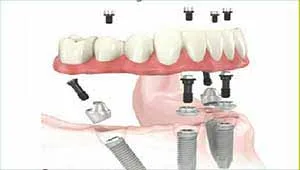 All on 4 Dental Implants