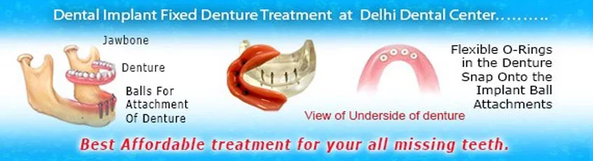 Dental Implant fixed Denture in Delhi India