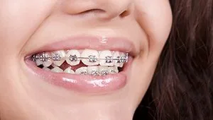 braces png