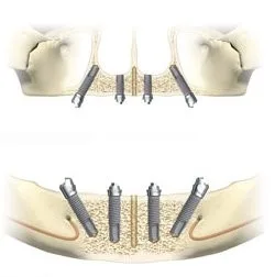 Full Mouth all-On-4 Dental Implants In Delhi India 15 gfdgfdgfdg