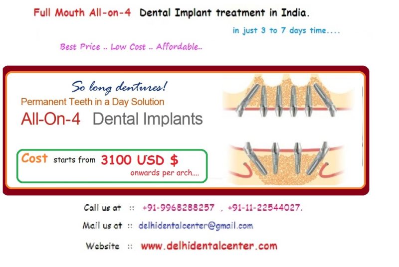 3100 all on 4 treatment India. 800x536 1