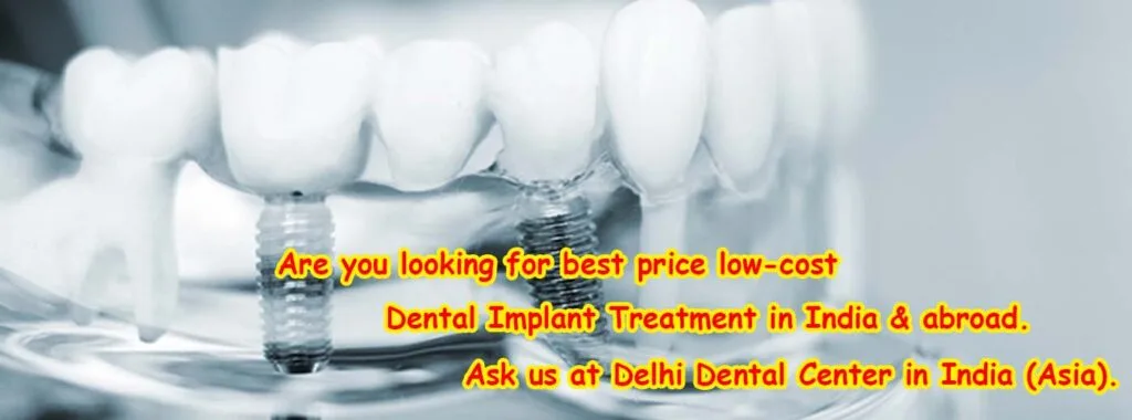 Best Full Mouth Dental Implants Treatment in India 1 Dental Implants Treatment in India