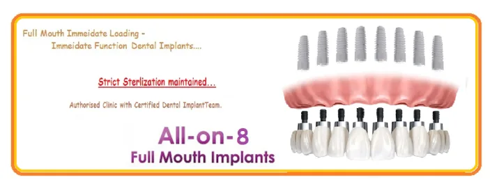 Blogs 22 All on 8 Treatment Procedure 2