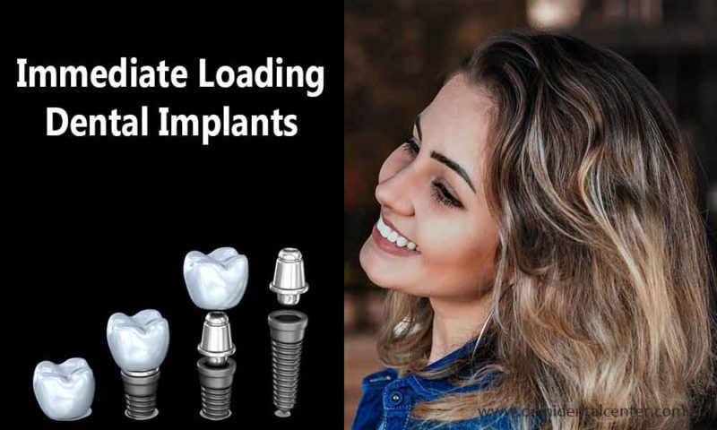 Dental Implants Immediate Loading 800x480 1