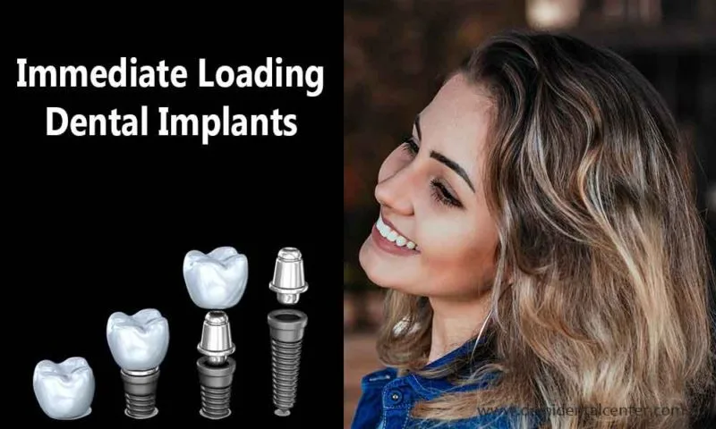 Blogs 2 Dental Implants Immediate Loading 800x480 1