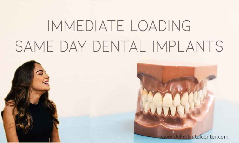 Dental Implants Immediate Loading Same Day 800x480 1