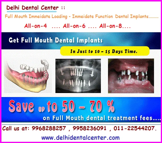 Blogs 38 Full Mouth Immediate Loading Implants India 1