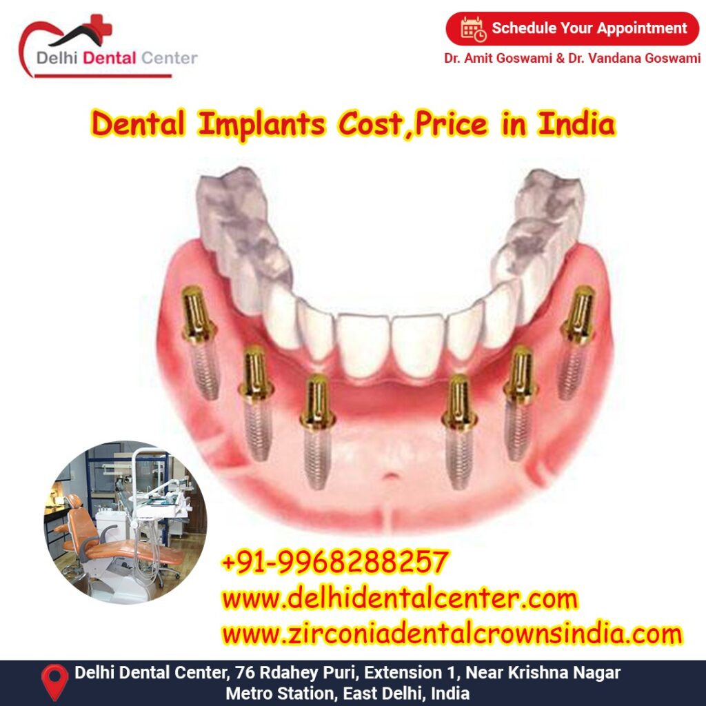 Best Top Full Mouth Dental Implant, Full Mouth all-on-4, all-on-6, all-on-8 Immediate Dental Implants Abroad in India.