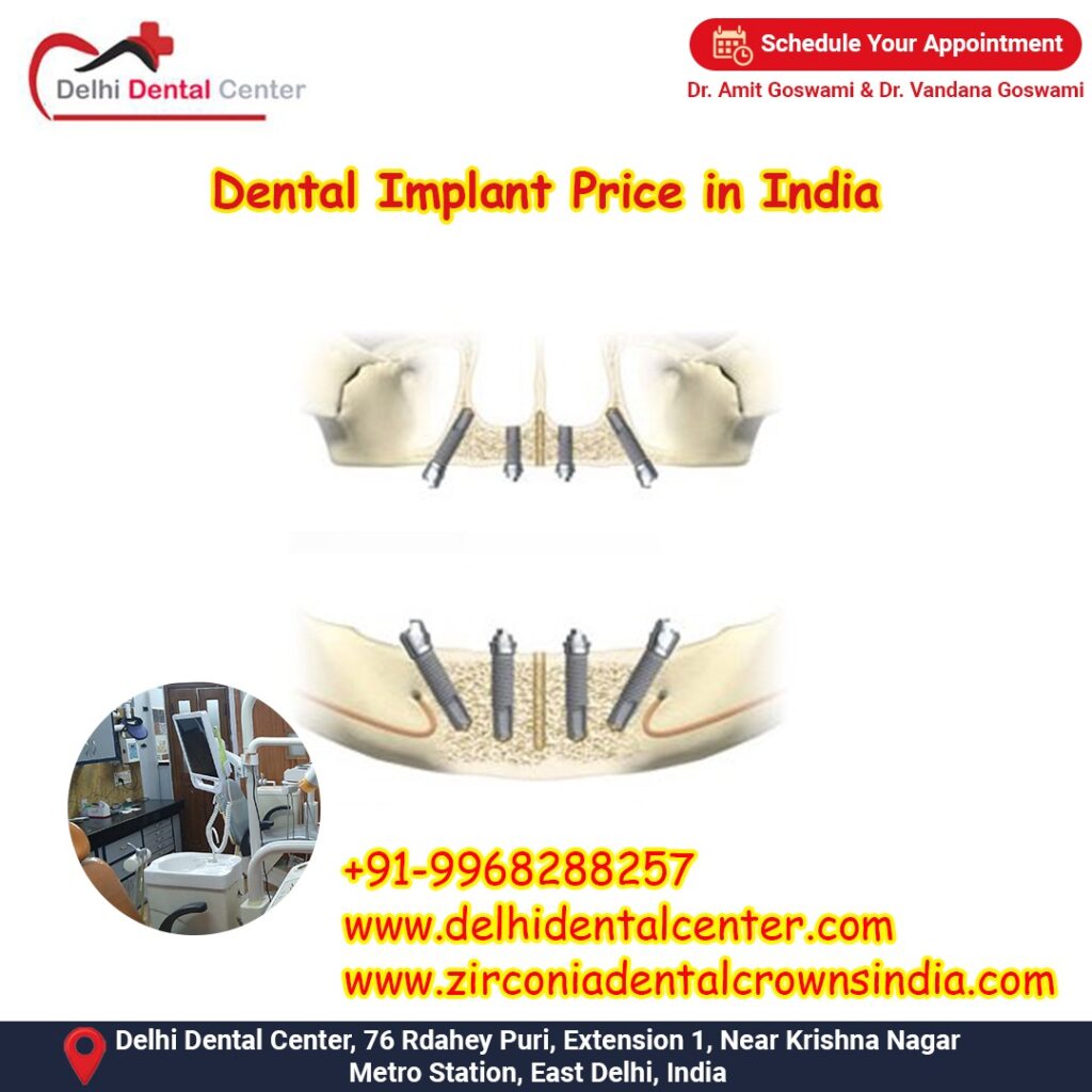 Best Top Full Mouth Dental Implant, Best price low cost cheap Dental Implants Abroad, Dental Tourism India, cheap dental implants abroad.