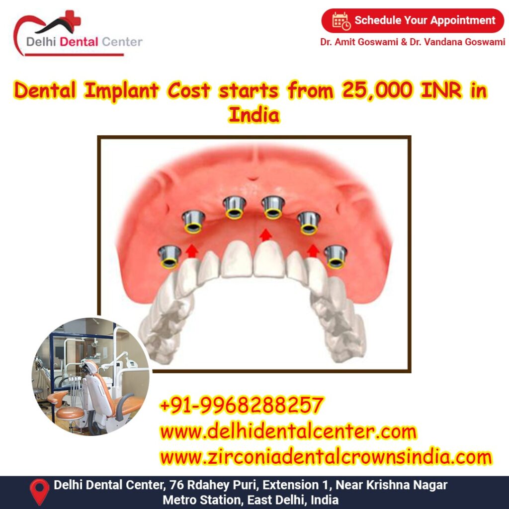 Best Top Full Mouth Dental Implant, Dental Implants Abroad, Dental Tourism India, Dental Implant Tourism India.