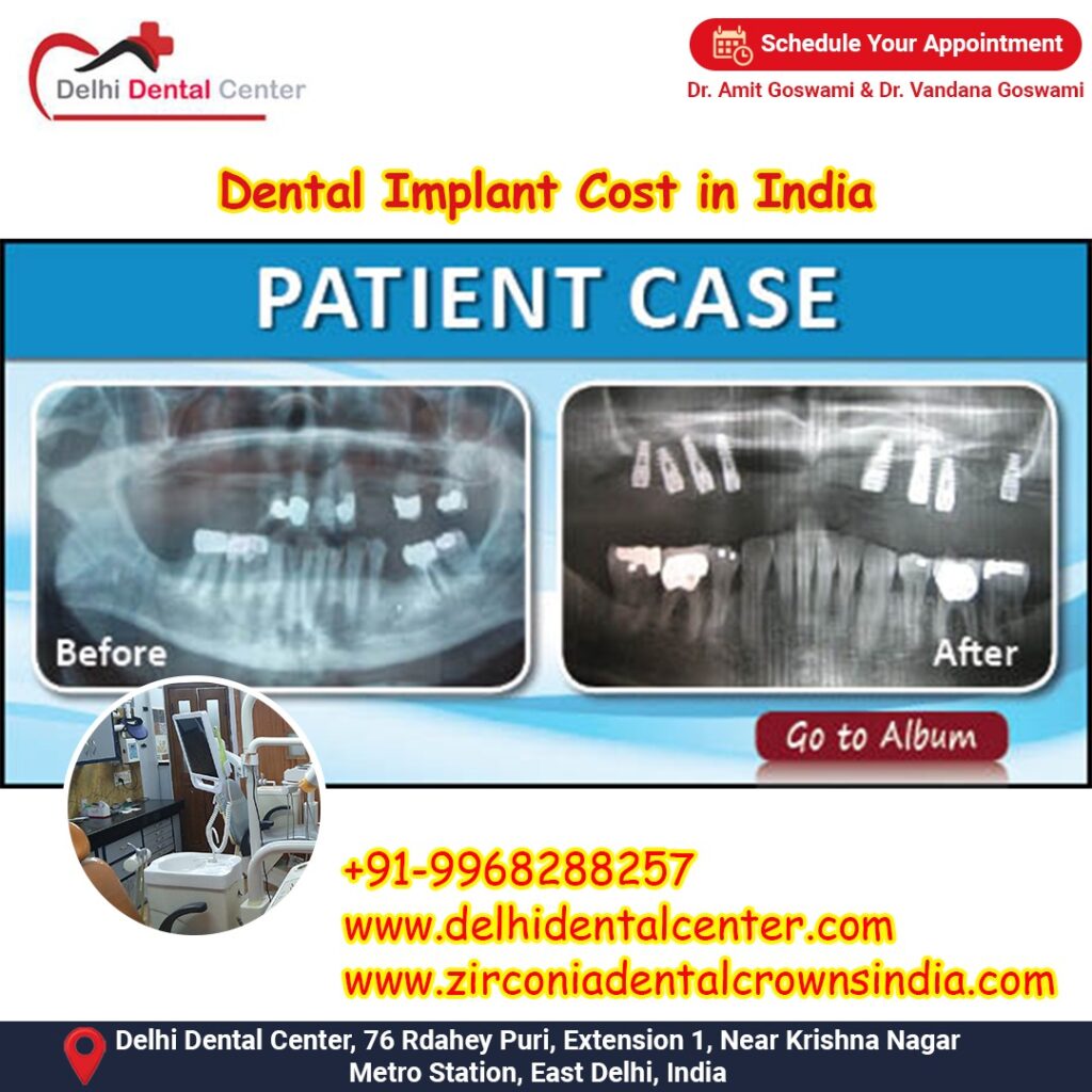 Best Top Full Mouth Dental Implant, Dental Implant Clinic India.