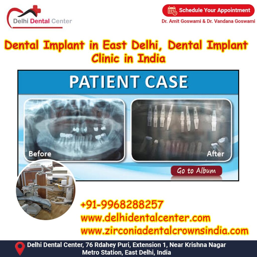 Best Top Full Mouth Dental Implant, Dental Implant India