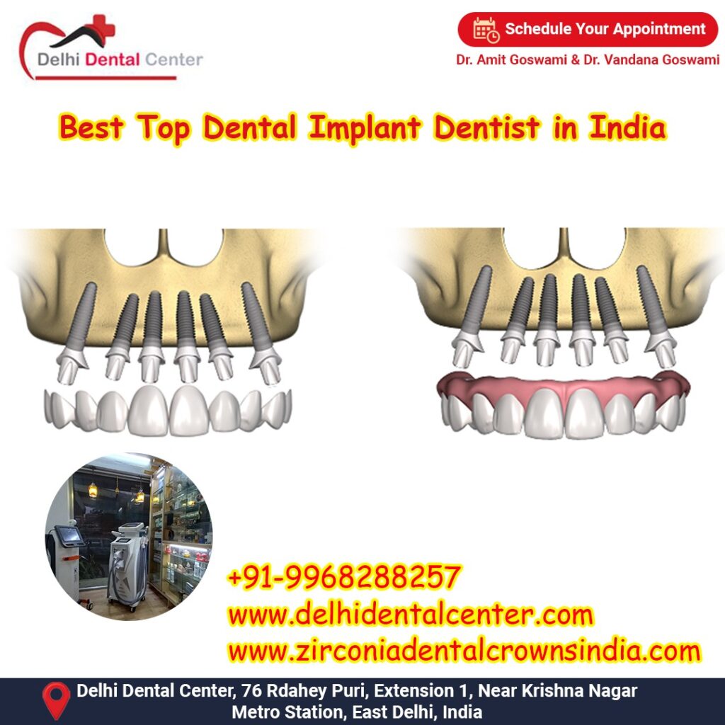 Best Top Full Mouth Dental Implant, Dental Implant Dentist India
