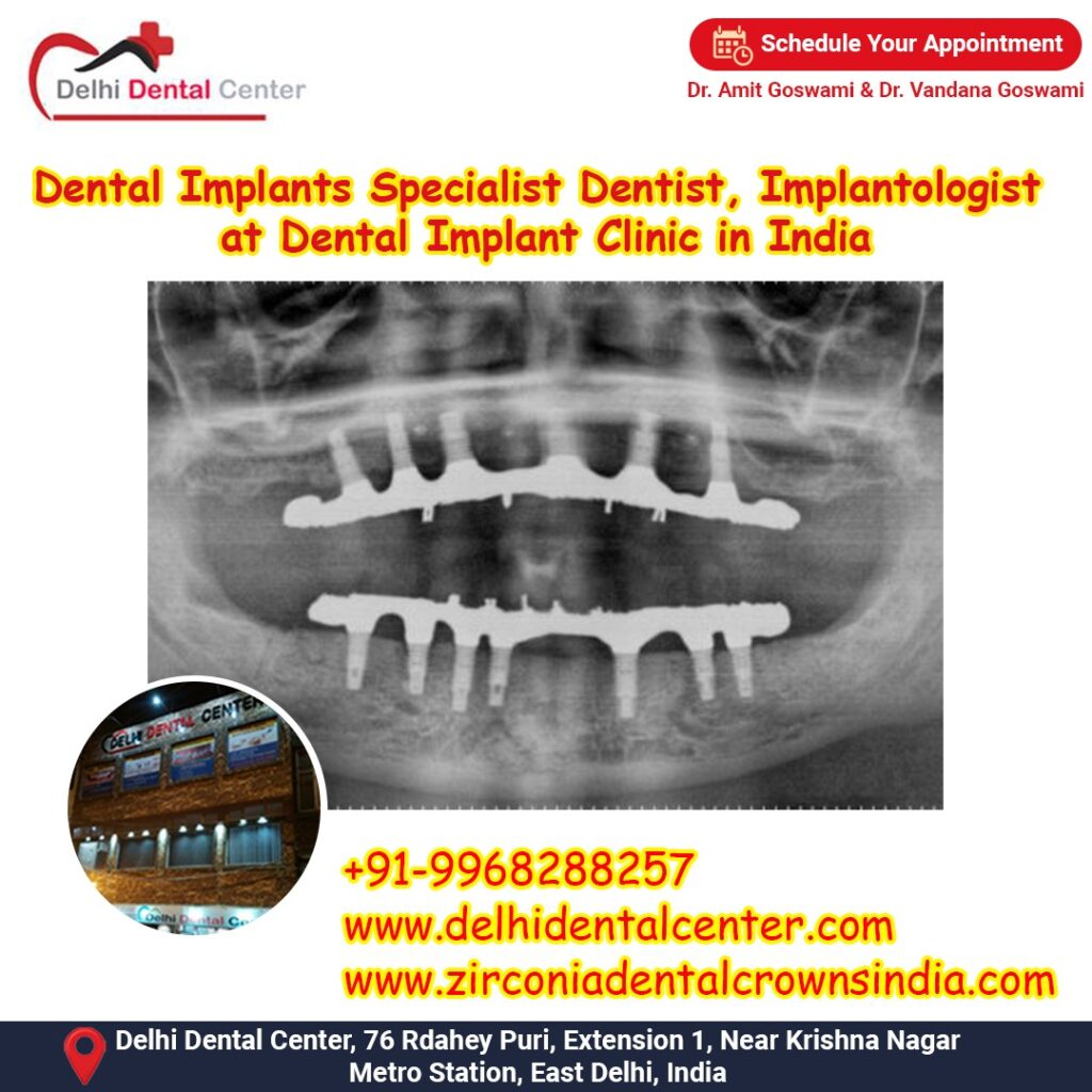 Best Top Full Mouth Dental Implant, Best Top Painless Dental Implant surgery India.