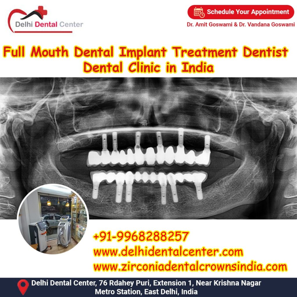 Best Top Full Mouth Dental Implant, Best Top Dental Implant procedure in India.