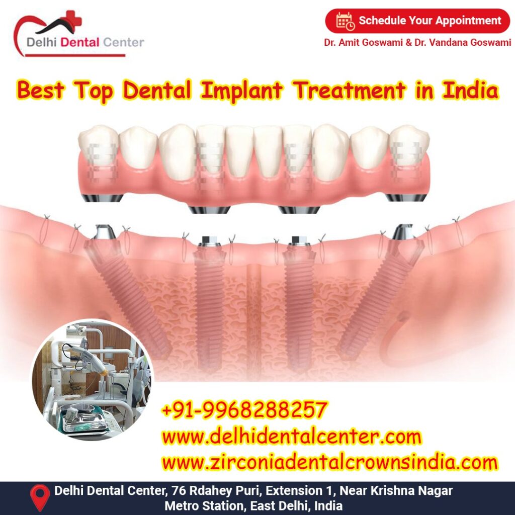 Best Top Full Mouth Dental Implant, Best Top Dental Implant Treatment in India.