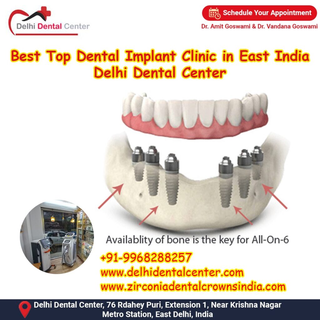 Best Top Full Mouth Dental Implant, Best Top Dental Implant Clinic in India – Delhi Dental Center