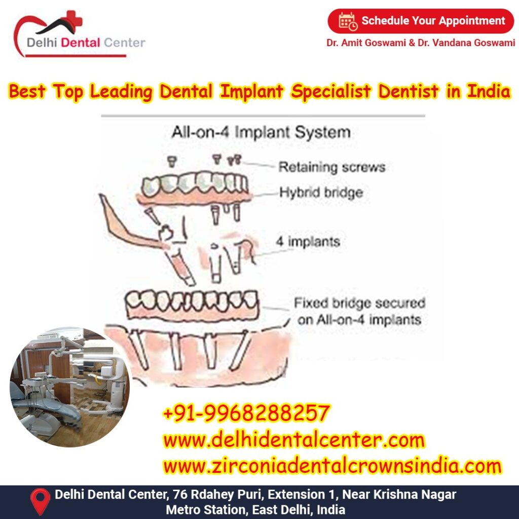Best Top Full Mouth Dental Implant, Dental Implant in India, Dental Implant Clinic in India