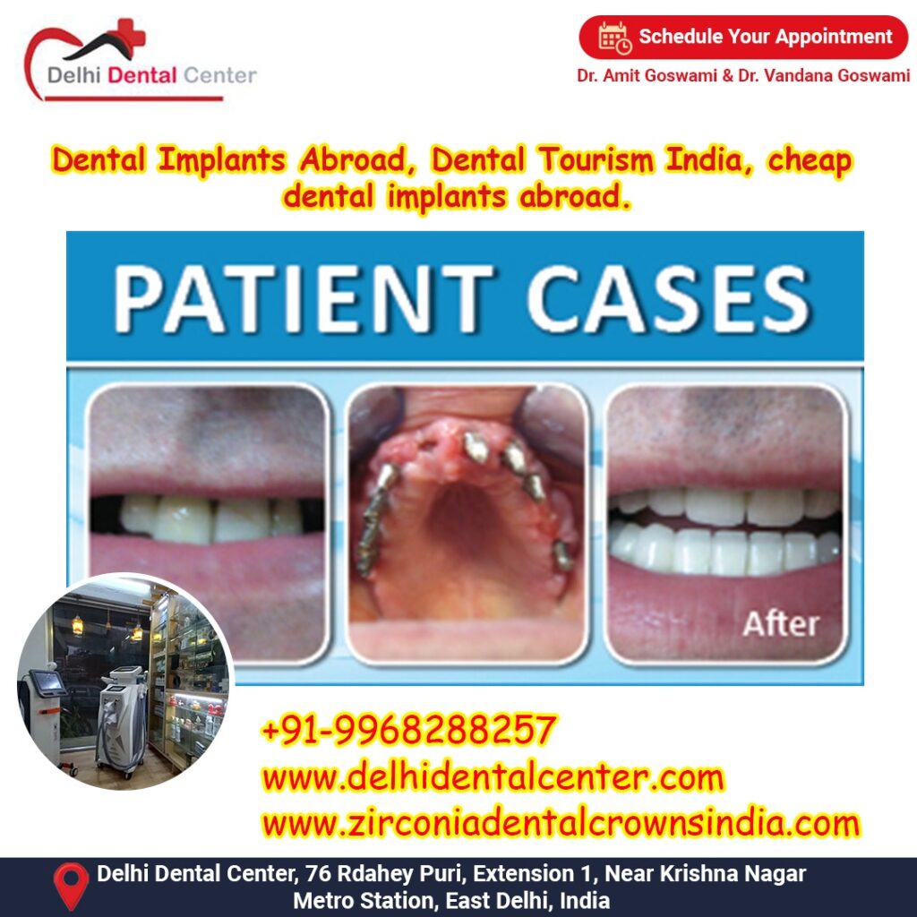 Best Top Full Mouth Dental Implant, Dental Implant Price starts from 25,000 INR in India