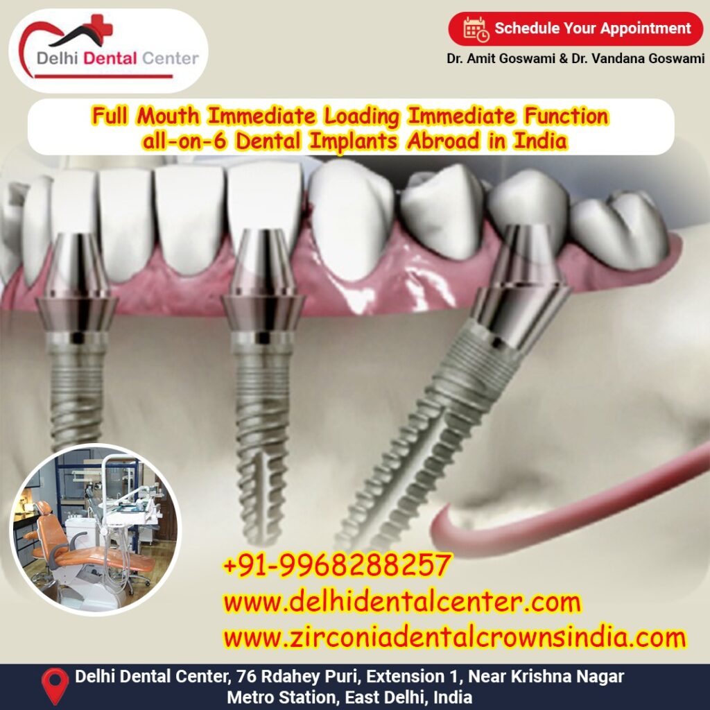 Best Top Full Mouth Dental Implant,, Dental Implants Abroad, Dental Tourism India, Dental Implants India