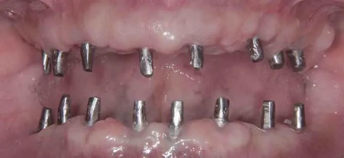 Blogs 9 Implants Copy