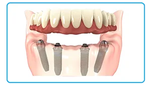 Full Mouth all-On-4 Dental Implants In Delhi India 2 aaaaa