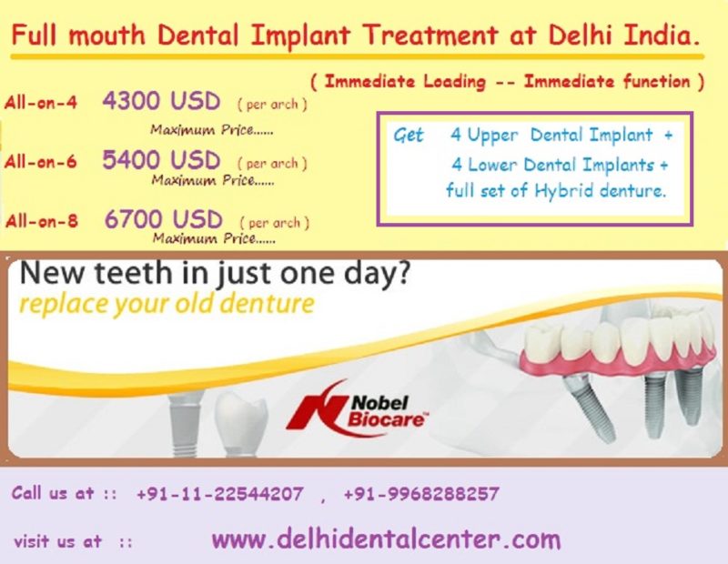 all on 4 immediate dental implant cost Delhi India. 800x620 1