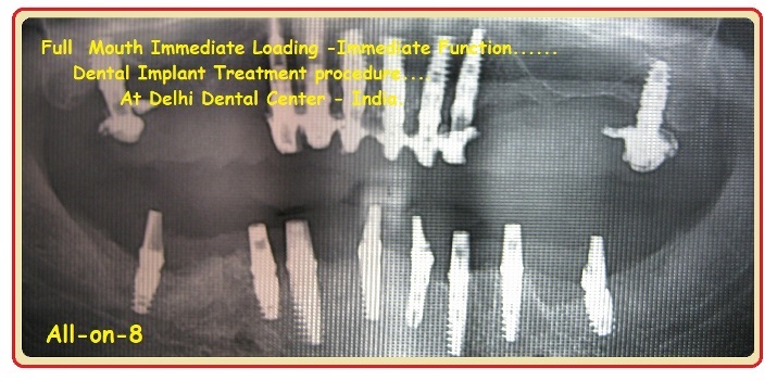 all on 8 dental implants 1