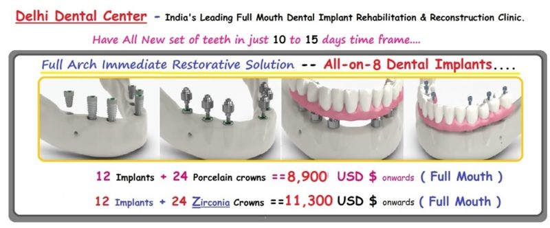 full mouth all on 8 dental implant price cost Delhi Inida Banner Copy 800x332 2
