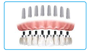 Full Mouth All-on-8 Dental Implant in Delhi India