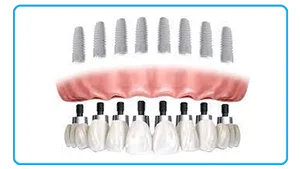 Full Mouth All-on-8 Dental Implant in Delhi India