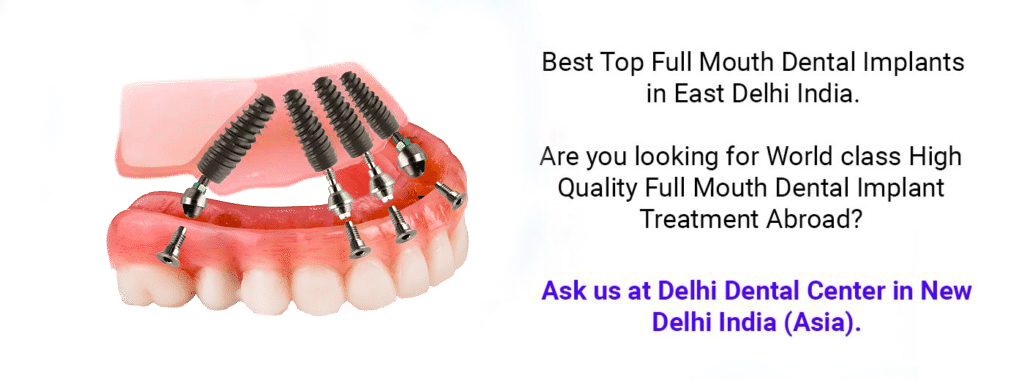 Full Mouth Dental Implant Treatment in East Delhi