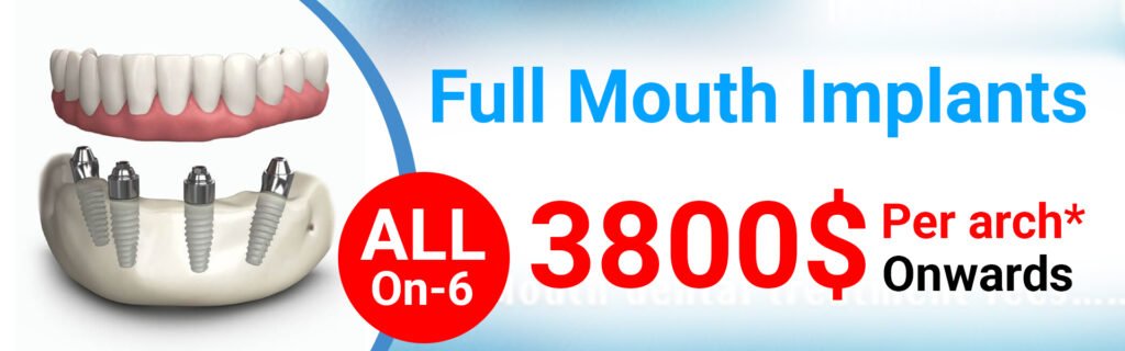 Full Mouth All-On-6 Dental Implants In Delhi India