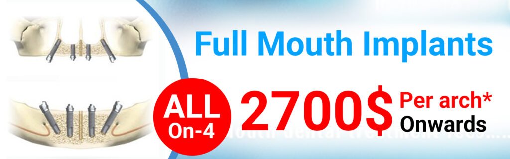 Full Mouth all-On-4 Dental Implants In Delhi India