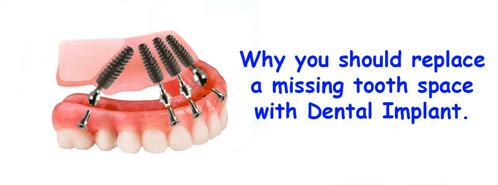 Why you should replace a missing tooth space with Dental Implant