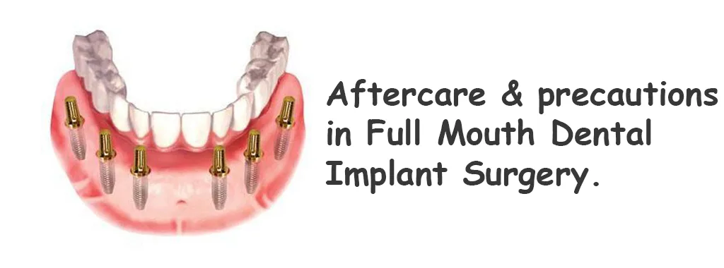 How to take care of your dental implant 1 djlkasjdlkjadjasldjalsdjljds