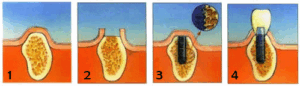 4 Implant Stages